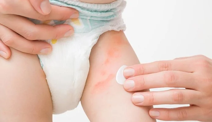 Diaper Rash Treatments